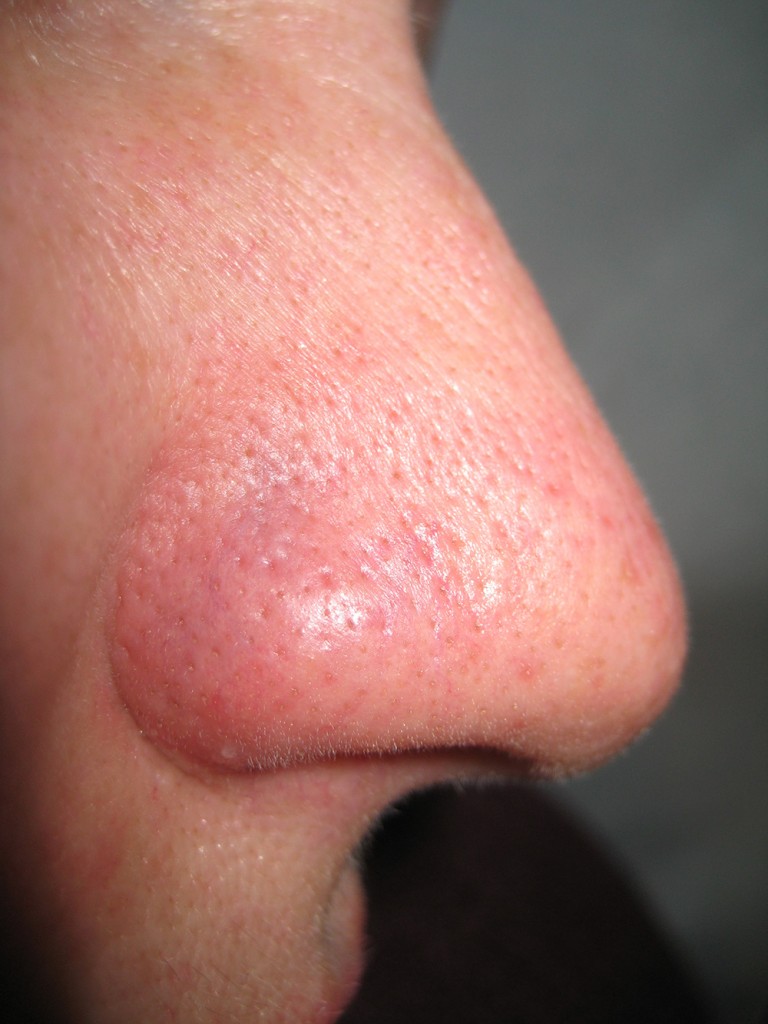 Teleangectasie Nase vor und nach der Behandlung 10