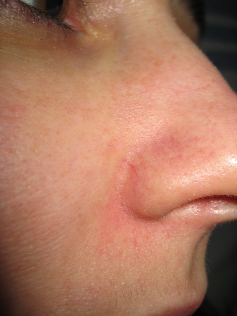 Teleangectasie Nase vor und nach der Behandlung 11