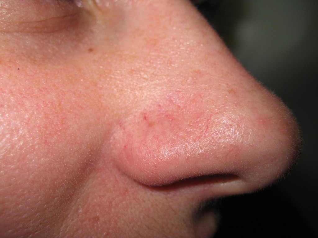 Teleangectasie Nase vor und nach der Behandlung 13