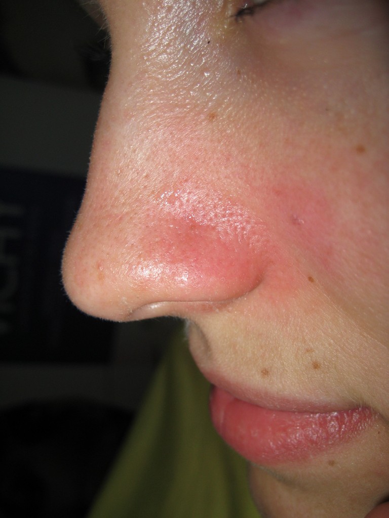 Teleangectasie Nase vor und nach der Behandlung 18