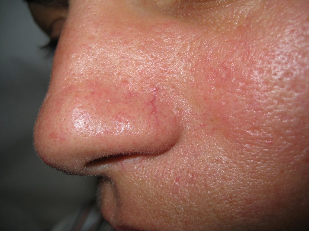 Teleangectasie nas înainte şi după tratament 1
