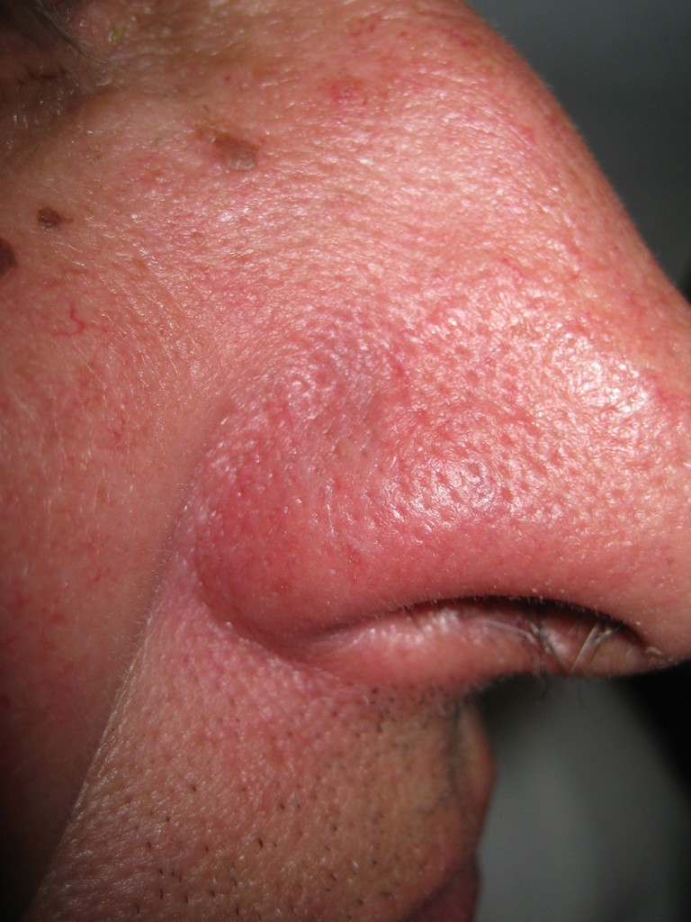 Teleangectasie nas înainte şi după tratament 4