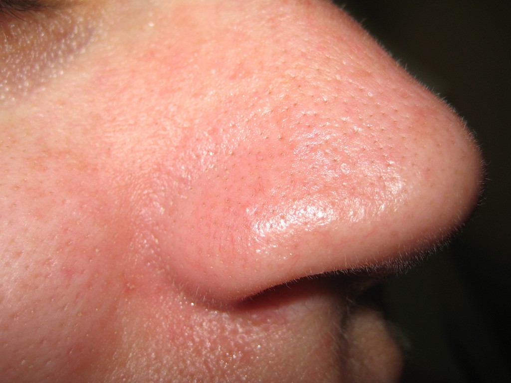 Teleangectasie nas înainte şi după tratament 6