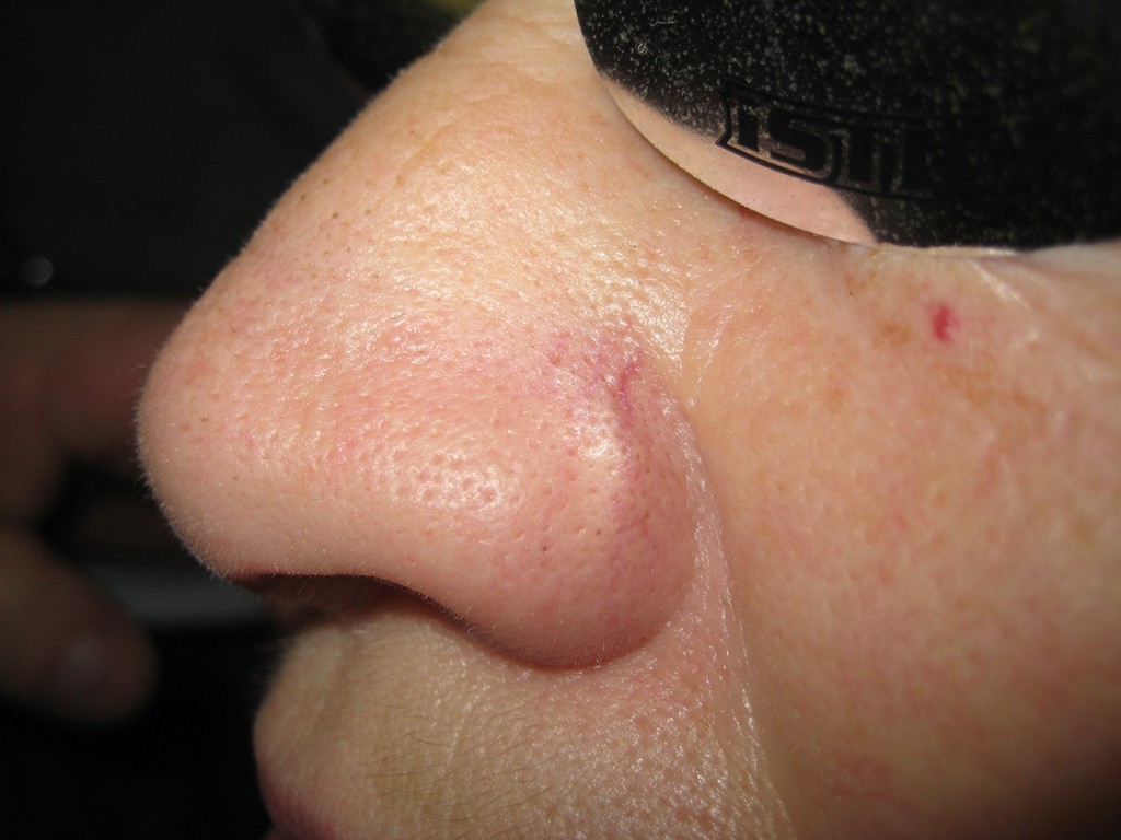 Teleangectasie nas înainte şi după tratament 7