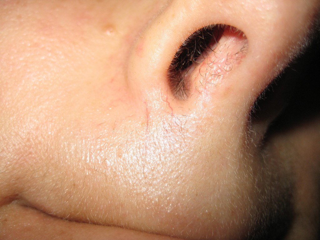 Teleangectasie nas înainte şi după tratament 21