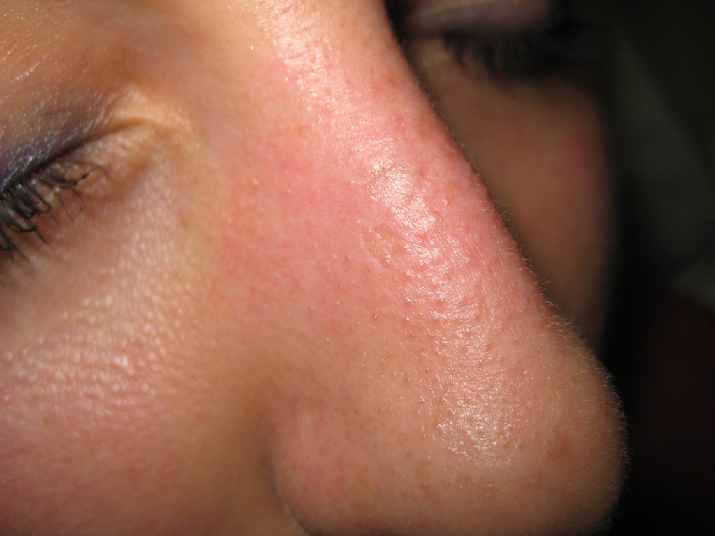 Teleangectasie nas înainte şi după tratament 26